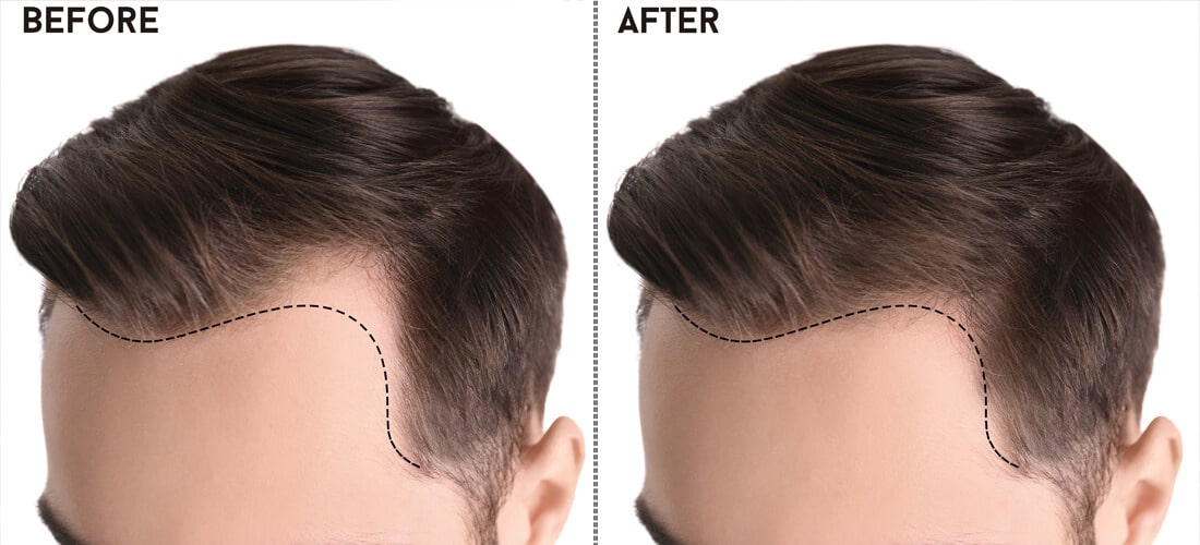 Unveiling Excellence: The Quest for the Best Hair Transplant