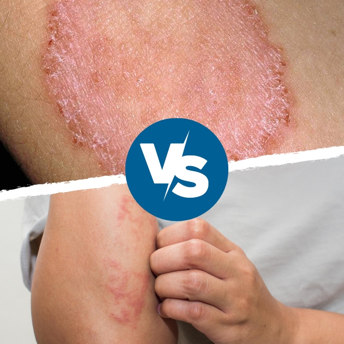 Eczema, Psoriasis, and Ringworm: What To Know