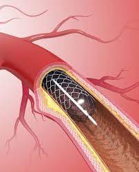 Coronary Angioplasty in Jaipur: A Lifeline for Heart Health
