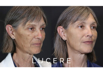 How Long Does Lip Filler Last?