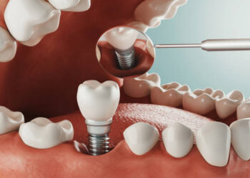 The Long-Term Benefits of Dental Implants for Your Oral Health
