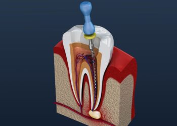 Root Canal Therapy: Saving Your Natural Teeth with Expert Care at TS Oral Health