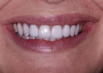 Clear Aligners Flint, MI: Your Complete Guide to Achieving a Perfect Smile